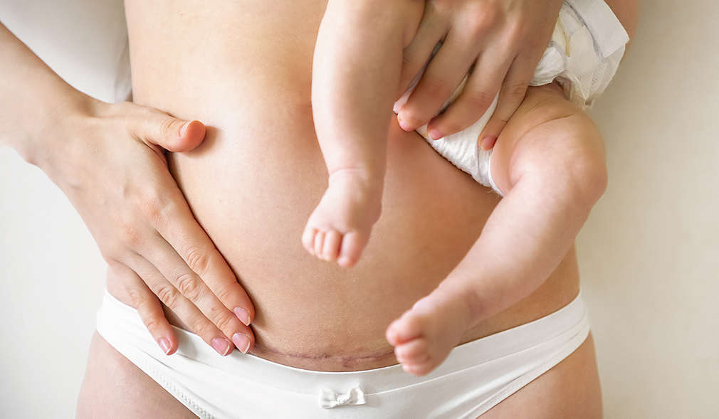 Frau mit Kaiserschnittnarbe und Baby im Arm